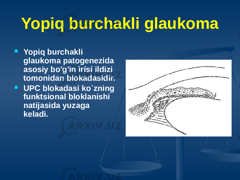 Yopiq burchakli glaukoma  Yopiq burchakli glaukoma patogenezida asosiy bo&#39;g&#39;in ìrísí ildizi tomonidan blokadasidir.  UPC blokadasi ko`zning funktsional bloklanishi natijasida yuzaga keladi. 