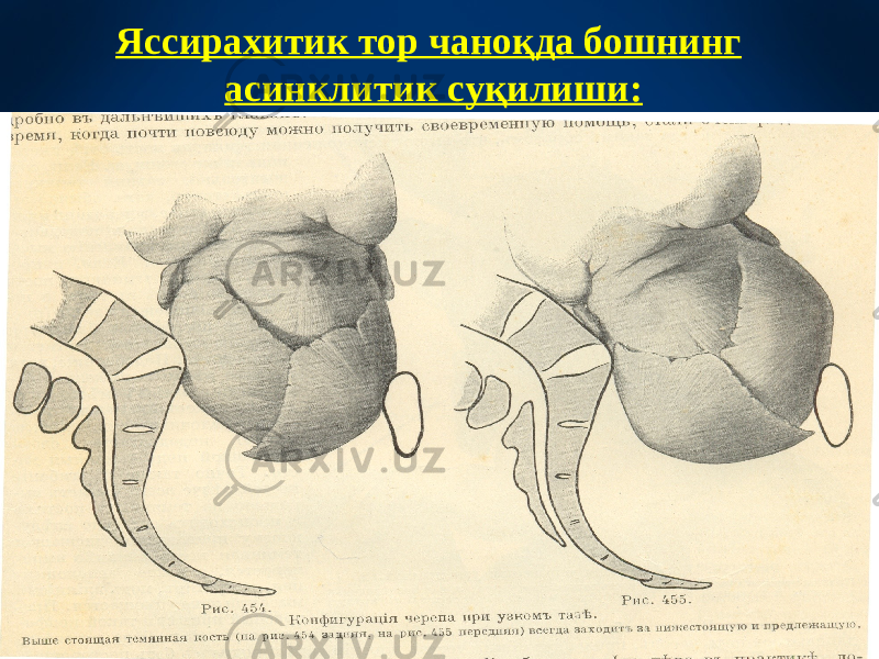 Яссирахитик тор чаноқда бошнинг асинклитик суқилиши: 