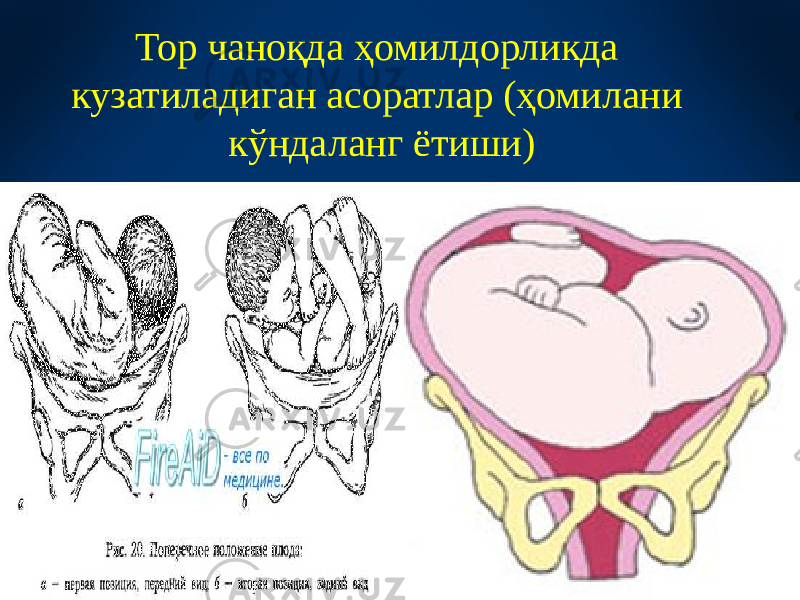 Тор чаноқда ҳомилдорликда кузатиладиган асоратлар (ҳомилани кўндаланг ётиши) 