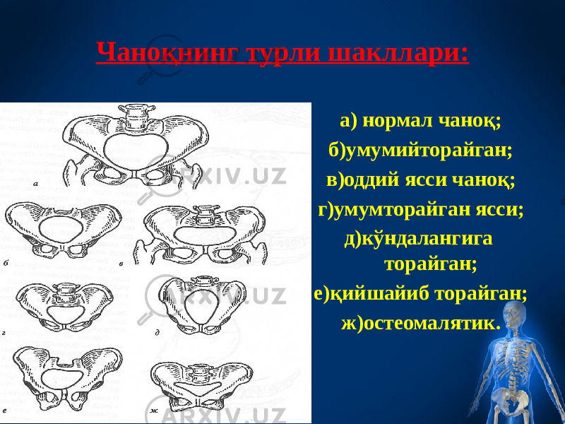 Чаноқнинг турли шакллари: а) нормал чаноқ; б)умумийторайган; в)оддий ясси чаноқ; г)умумторайган ясси; д)кўндалангига торайган; е)қийшайиб торайган; ж)остеомалятик. 