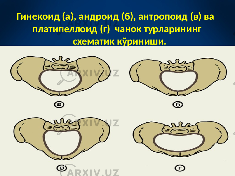 Гинекоид (а), андроид (б), антропоид (в) ва платипеллоид (г) чанок турларининг схематик кўриниши. 