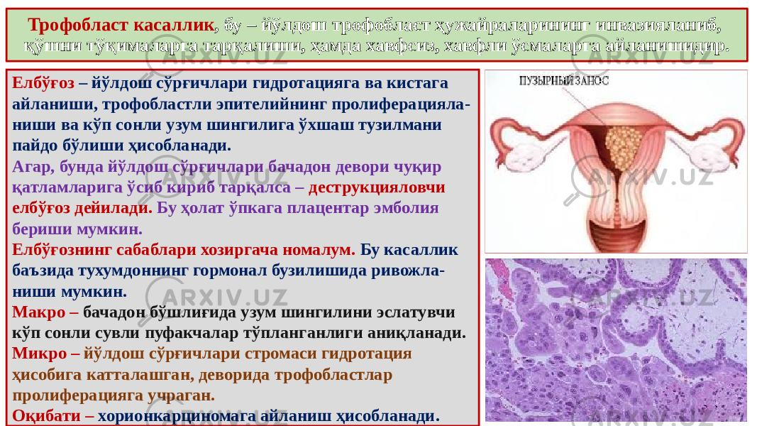 Трофобласт касаллик , бу – йўлдош трофобласт ҳужайраларининг инвазияланиб, қўшни тўқималарга тарқалиши, ҳамда хавфсиз, хавфли ўсмаларга айланишидир. Елбўғоз – йўлдош сўрғичлари гидротацияга ва кистага айланиши, трофобластли эпителийнинг пролиферацияла- ниши ва кўп сонли узум шингилига ўхшаш тузилмани пайдо бўлиши ҳисобланади. Агар, бунда йўлдош сўрғичлари бачадон девори чуқир қатламларига ўсиб кириб тарқалса – деструкцияловчи елбўғоз дейилади. Бу ҳолат ўпкага плацентар эмболия бериши мумкин. Елбўғознинг сабаблари хозиргача номалум. Бу касаллик баъзида тухумдоннинг гормонал бузилишида ривожла- ниши мумкин. Макро – бачадон бўшлиғида узум шингилини эслатувчи кўп сонли сувли пуфакчалар тўпланганлиги аниқланади. Микро – йўлдош сўрғичлари стромаси гидротация ҳисобига катталашган, деворида трофобластлар пролиферацияга учраган. Оқибати – хорионкарциномага айланиш ҳисобланади. 