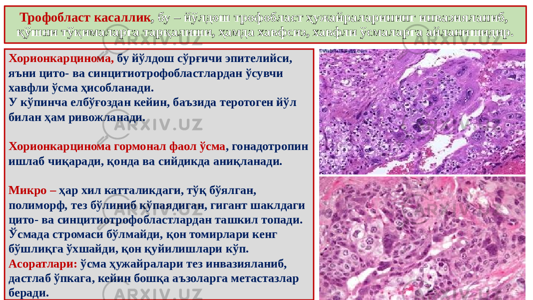 Трофобласт касаллик , бу – йўлдош трофобласт ҳужайраларининг инвазияланиб, қўшни тўқималарга тарқалиши, ҳамда хавфсиз, хавфли ўсмаларга айланишидир. Хорионкарцинома, бу йўлдош сўрғичи эпителийси, яъни цито- ва синцитиотрофобластлардан ўсувчи хавфли ўсма ҳисобланади. У кўпинча елбўғоздан кейин, баъзида теротоген йўл билан ҳам ривожланади. Хорионкарцинома гормонал фаол ўсма , гонадотропин ишлаб чиқаради, қонда ва сийдикда аниқланади. Микро – ҳар хил катталикдаги, тўқ бўялган, полиморф, тез бўлиниб кўпаядиган, гигант шаклдаги цито- ва синцитиотрофобластлардан ташкил топади. Ўсмада стромаси бўлмайди, қон томирлари кенг бўшлиқга ўхшайди, қон қуйилишлари кўп. Асоратлари: ўсма ҳужайралари тез инвазияланиб, дастлаб ўпкага, кейин бошқа аъзоларга метастазлар беради. 