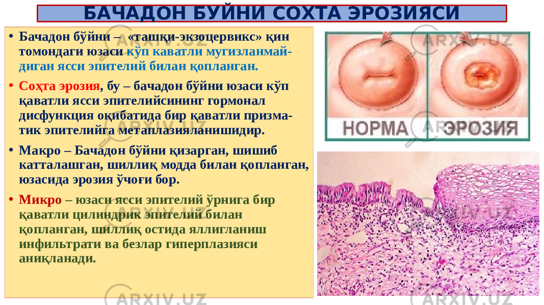 БАЧАДОН БУЙНИ СОХТА ЭРОЗИЯСИ • Бачадон бўйни – «ташқи-экзоцервикс» қин томондаги юзаси кўп каватли мугизланмай- диган ясси эпителий билан қопланган. • Соҳта эрозия , бу – бачадон бўйни юзаси кўп қаватли ясси эпителийсининг гормонал дисфункция оқибатида бир қаватли призма- тик эпителийга метаплазияланишидир. • Макро – Бачадон бўйни қизарган, шишиб катталашган, шиллиқ модда билан қопланган, юзасида эрозия ўчоғи бор. • Микро – юзаси ясси эпителий ўрнига бир қаватли цилиндрик эпителий билан қопланган, шиллиқ остида яллигланиш инфильтрати ва безлар гиперплазияси аниқланади. Цервикс 