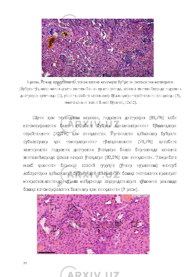 1-расм. Ўткир нурланиш олган оқ зотсиз каламуш буйраги гистологик манзараси (буйрак тўқимаси мағиз қавати эпителийси оч пушти рангда, каналча эпителийларида гидропик дистрофия кузатилди (1), унинг ҳисобига каналчалар бўшлиқлари торайганлиги аниқланди (2), гематоксилин-эозин билан бўялган, 10х10). Шуни ҳам таъкидлаш керакки, гидропик дистрофия (86,7%) каби патоморфологик белги ҳисобига буйрак каналчаларининг бўшлиқлари торайганлиги (70,0%) ҳам аниқланган. Ўрганилган ҳайвонлар буйраги субкапсуляр қон томирларининг тўлақонлилиги (76,7%) ҳисобига келтирилган гидропик дистропия ўчоқлари билан биргаликда каналча эпителийларида фокал некроз ўчоқлари (80,0%) ҳам аниқланган. Тажрибага жалб қилинган биринчи асосий гуруҳга (ўткир нурланиш) мансуб лаборатория ҳайвонлари буйрагидан тайёрланган бошқа гистологик препарат микроскопланганда кўриш майдонида юқоридагиларга қўшимча равишда бошқа патоморфологик белгилар ҳам аниқланган (2-расм). 22 1 1 2 1 1 2 3 3 4 4 