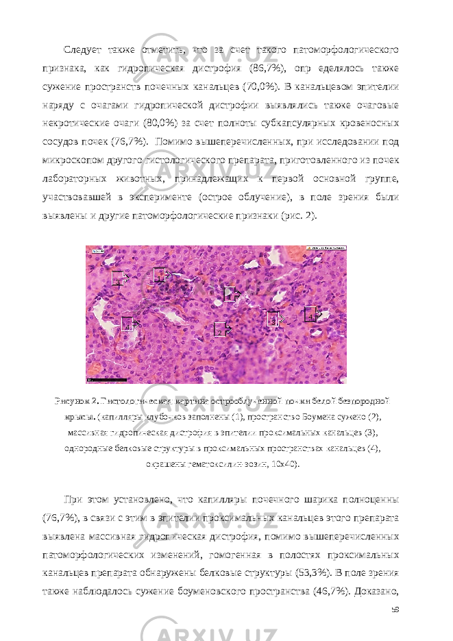 Следует также отметить, что за счет такого патоморфологического признака, как гидропическая дистрофия (86,7%), опр еделялось также сужение пространств почечных канальцев (70,0%). В канальцевом эпителии наряду с очагами гидропической дистрофии выявлялись также очаговые некротические очаги (80,0%) за счет полноты субкапсулярных кровеносных сосудов почек (76,7%). Помимо вышеперечисленных, при исследовании под микроскопом другого гистологического препарата, приготовленного из почек лабораторных животных, принадлежащих к первой основной группе, участвовавшей в эксперименте (острое облучение), в поле зрения были выявлены и другие патоморфологические признаки (рис. 2). Рисунок 2. Гистологическая картина острооблученной почки белой безпородной крысы. (капилляры клубочков заполнены (1), пространство Боумена сужено (2), массивная гидропическая дистрофия в эпителии проксимальных канальцев (3), однородные белковые структуры в проксимальных пространствах канальцев (4), окрашены гематоксилин-эозин, 10х40). При этом установлено, что капилляры почечного шарика полноценны (76,7%), в связи с этим в эпителии проксимальных канальцев этого препарата выявлена массивная гидропическая дистрофия, помимо вышеперечисленных патоморфологических изменений, гомогенная в полостях проксимальных канальцев препарата обнаружены белковые структуры (53,3%). В поле зрения также наблюдалось сужение боуменовского пространства (46,7%). Доказано, 59 1 1 2 3 3 4 4 