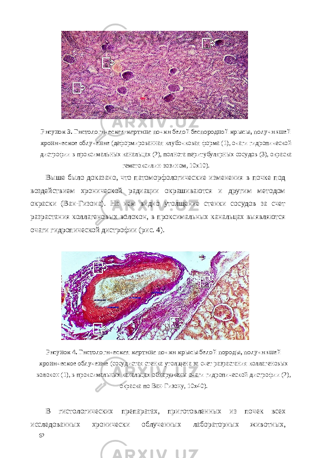 Рисунок 3. Гистологическая картина почки белой беспородной крысы, получившей хроническое облучение (деформированная клубочковая форма (1), очаги гидропической дистрофии в проксимальных канальцах (2), полнота перитубулярных сосудов (3), окраска гематоксилин-эозином, 10х10). Выше было доказано, что патоморфологические изменения в почке под воздействием хронической радиации окрашиваются и другим методом окраски (Ван-Гизона). На нем видно утолщение стенки сосудов за счет разрастания коллагеновых волокон, в проксимальных канальцах выявляются очаги гидропической дистрофии (рис. 4). Рисунок 4. Гистологическая картина почки крысы белой породы, получившей хроническое облучение (сосудистая стенка утолщена за счет разрастания коллагеновых волокон (1), в проксимальных канальцах обнаружены очаги гидропической дистрофии (2), окраска по Ван-Гизону, 10х40). В гистологических препаратах, приготовленных из почек всех исследованных хронически облученных лабораторных животных, 62 1 2 3 1 1 2 2 