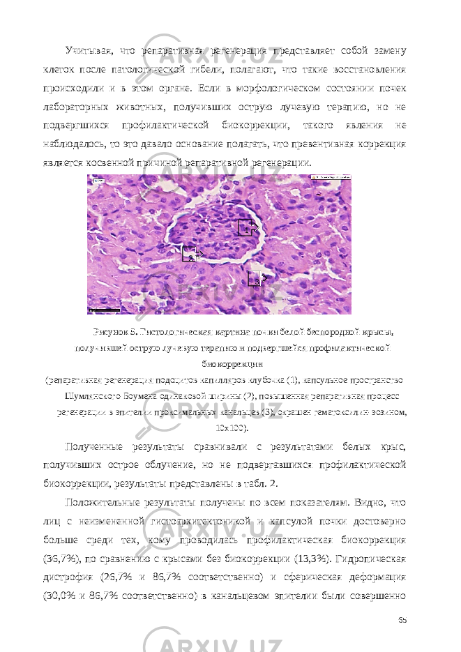 Учитывая, что репаративная регенерация представляет собой замену клеток после патологической гибели, полагают, что такие восстановления происходили и в этом органе. Если в морфологическом состоянии почек лабораторных животных, получивших острую лучевую терапию, но не подвергшихся профилактической биокоррекции, такого явления не наблюдалось, то это давало основание полагать, что превентивная коррекция является косвенной причиной репаративной регенерации. Рисунок 5. Гистологическая картина почки белой беспородной крысы, получившей острую лучевую терапию и подвергшейся профилактической биокоррекции (репаративная регенерация подоцитов капилляров клубочка (1), капсульное пространство Шумлянского-Боумена одинаковой ширины (2), повышенная репаративная процесс регенерации в эпителии проксимальных канальцев (3), окрашен гематоксилин-эозином, 10х100). Полученные результаты сравнивали с результатами белых крыс, получивших острое облучение, но не подвергавшихся профилактической биокоррекции, результаты представлены в табл. 2. Положительные результаты получены по всем показателям. Видно, что лиц с неизмененной гистоархитектоникой и капсулой почки достоверно больше среди тех, кому проводилась профилактическая биокоррекция (36,7%), по сравнению с крысами без биокоррекции (13,3%). Гидропическая дистрофия (26,7% и 86,7% соответственно) и сферическая деформация (30,0% и 86,7% соответственно) в канальцевом эпителии были совершенно 65 1 2 3 