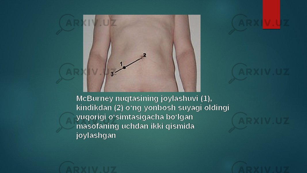 McBurney nuqtasining joylashuvi (1), kindikdan (2) oʻng yonbosh suyagi oldingi yuqorigi oʻsimtasigacha boʻlgan masofaning uchdan ikki qismida joylashgan 