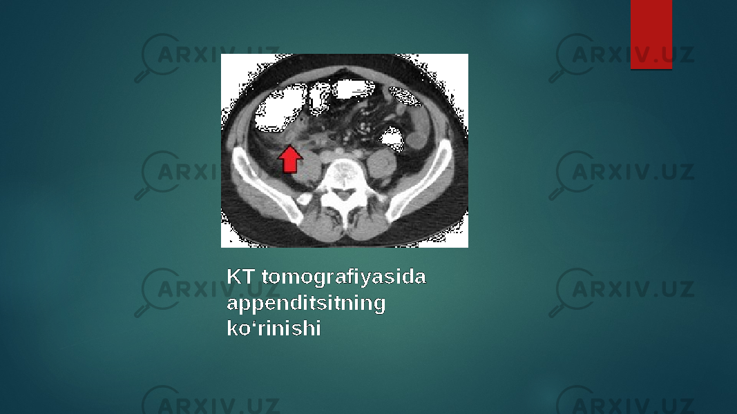 KT tomografiyasida appenditsitning koʻrinishi 