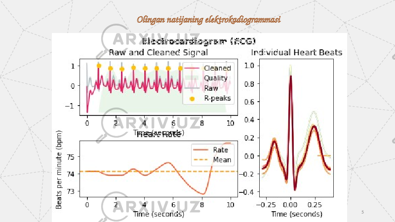 Olingan natijaning elektrokadiogrammasi 5 