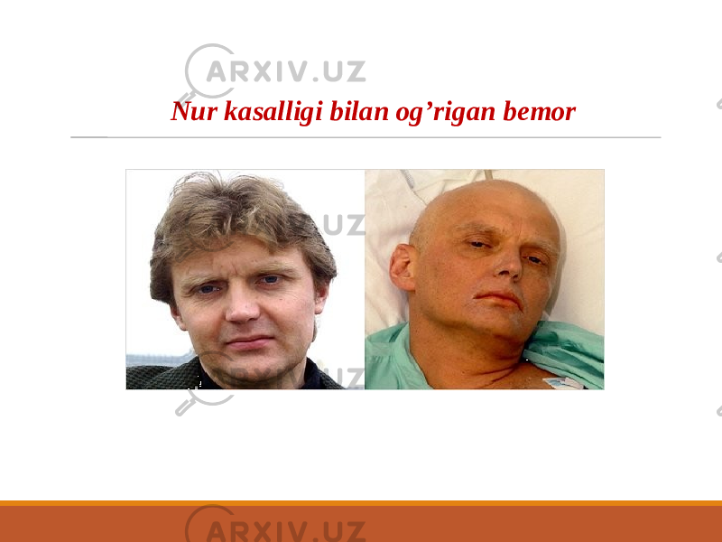 Nur kasalligi bilan og’rigan bemor 