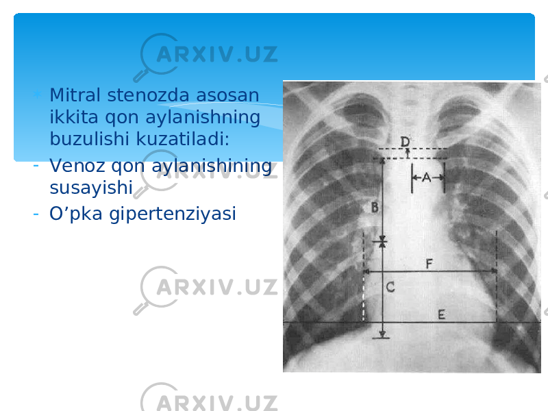  Mitral stenozda asosan ikkita qon aylanishning buzulishi kuzatiladi: - Venoz qon aylanishining susayishi - O’pka gipertenziyasi 