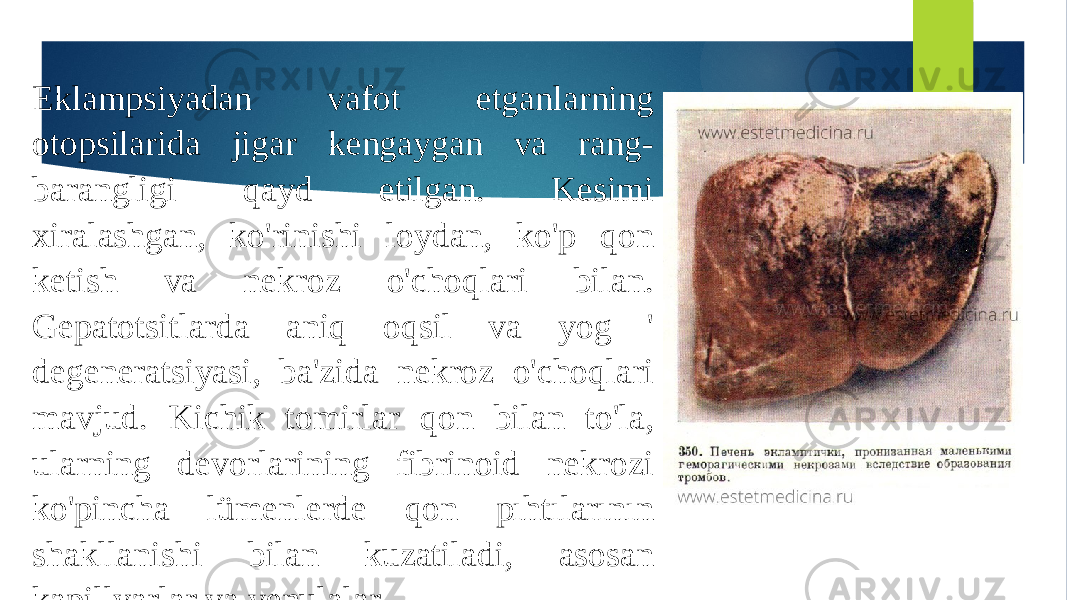 Eklampsiyadan vafot etganlarning otopsilarida jigar kengaygan va rang- barangligi qayd etilgan. Kesimi xiralashgan, ko&#39;rinishi loydan, ko&#39;p qon ketish va nekroz o&#39;choqlari bilan. Gepatotsitlarda aniq oqsil va yog &#39; degeneratsiyasi, ba&#39;zida nekroz o&#39;choqlari mavjud. Kichik tomirlar qon bilan to&#39;la, ularning devorlarining fibrinoid nekrozi ko&#39;pincha lümenlerde qon pıhtılarının shakllanishi bilan kuzatiladi, asosan kapillyarlar va venulalar . 