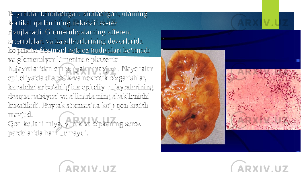 Buyraklar kattalashgan, xiralashgan, ularning kortikal qatlamining nekrozi tez-tez rivojlanadi. Glomeruliyalarning afferent arteriolalari va kapillyarlarining devorlarida ko&#39;pincha fibrinoid nekroz hodisalari ko&#39;rinadi va glomerulyar lümeninde platsenta hujayralaridan emboliyalar mavjud . Naychalar epiteliysida distrofik va nekrotik o&#39;zgarishlar, kanalchalar bo&#39;shlig&#39;ida epiteliy hujayralarining desquamatsiyasi va silindrlarning shakllanishi kuzatiladi. Buyrak stromasida ko&#39;p qon ketish mavjud. Qon ketishi miya, yurak va o&#39;pkaning seroz pardalarida ham uchraydi. 