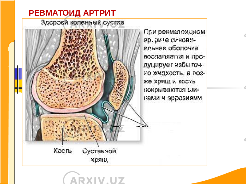 РЕВМАТОИД АРТРИТ 