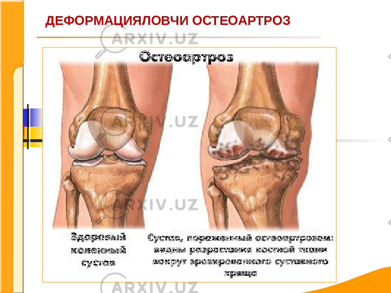 ДЕФОРМАЦИЯЛОВЧИ ОСТЕОАРТРОЗ 