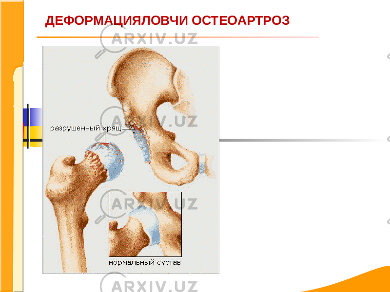 ДЕФОРМАЦИЯЛОВЧИ ОСТЕОАРТРОЗ 