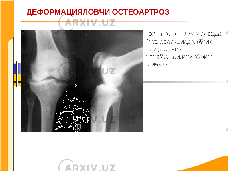 ДЕФОРМАЦИЯЛОВЧИ ОСТЕОАРТРОЗ рентгенограмма ларда 2 та проекцияда бўғим тирқишининг торайганлигини кўриш мумкин. . 