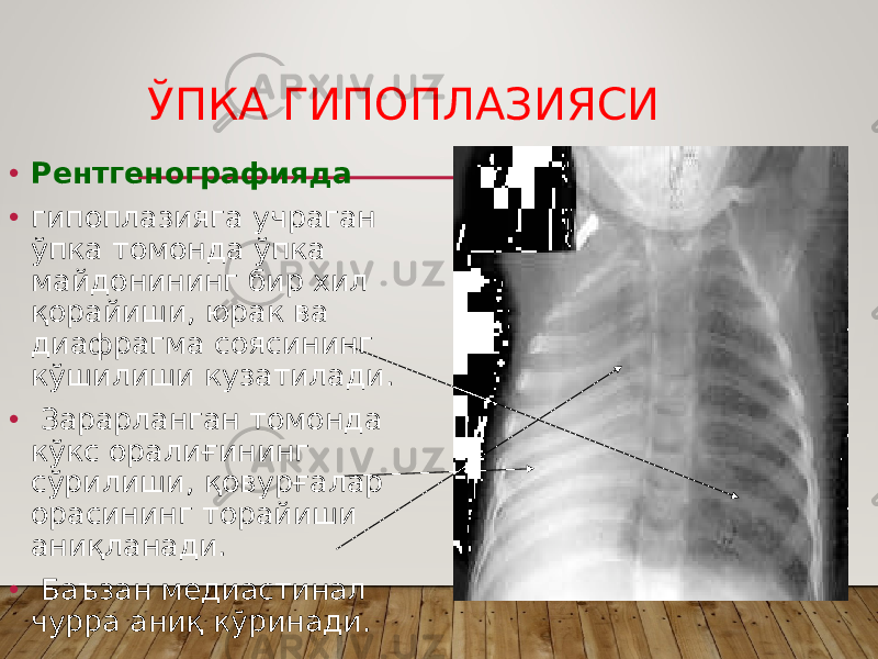 ЎПКА ГИПОПЛАЗИЯСИ • Рентгенографияда • гипоплазияга учраган ўпка томонда ўпка майдонининг бир хил қорайиши, юрак ва диафрагма соясининг кўшилиши кузатилади. • Зарарланган томонда кўкс оралиғининг сўрилиши, қовурғалар орасининг торайиши аниқланади. • Баъзан медиастинал чурра аниқ кўринади. 