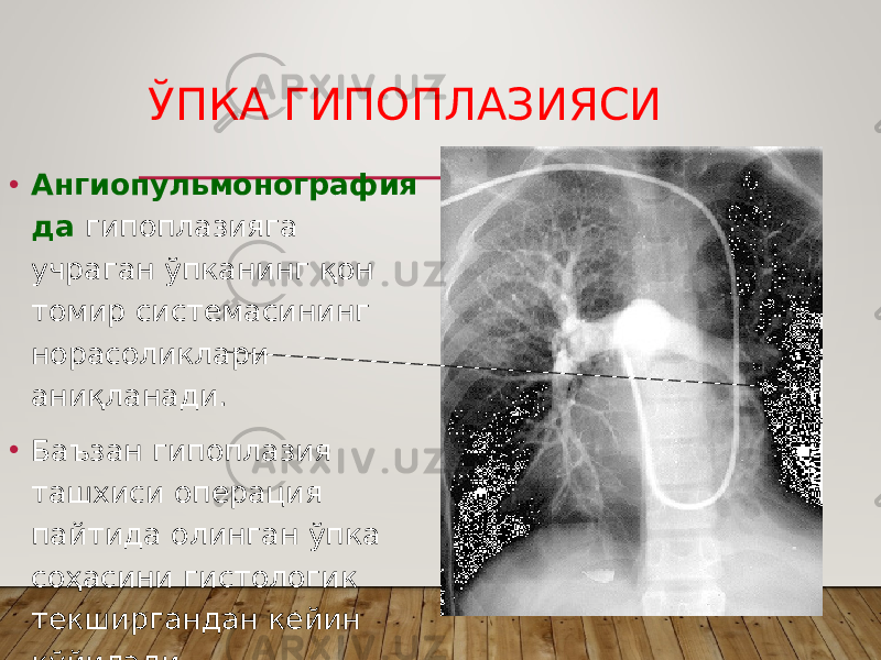 ЎПКА ГИПОПЛАЗИЯСИ • Ангиопульмонография да гипоплазияга учраган ўпканинг қон томир системасининг норасоликлари аниқланади. • Баъзан гипоплазия ташхиси операция пайтида олинган ўпка соҳасини гистологик текширгандан кейин қўйилади. 