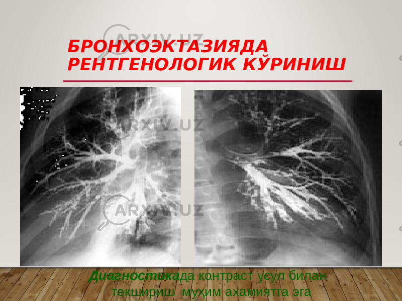 БРОНХОЭКТАЗИЯДА РЕНТГЕНОЛОГИК КЎРИНИШ Диагностика да контраст усул билан текшириш муҳим ахамиятга эга 