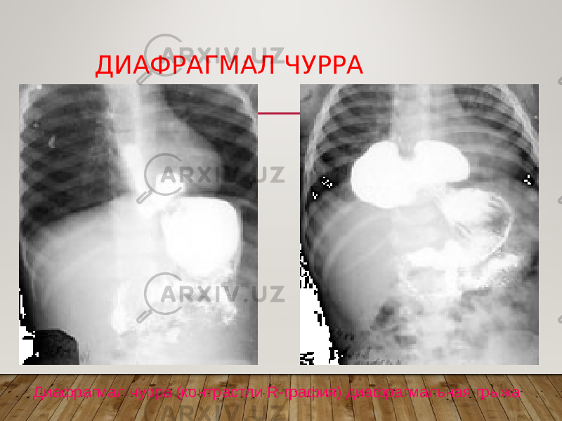 ДИАФРАГМАЛ ЧУРРА Диафрагмал чурра (контрастли R-графия) диафрагмальная грыжа 