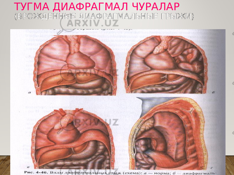 ТУГМА ДИАФРАГМАЛ ЧУРАЛАР (ВРОЖДЕННЫЕ ДИАФРАГМАЛЬНЫЕ ГРЫЖИ) 