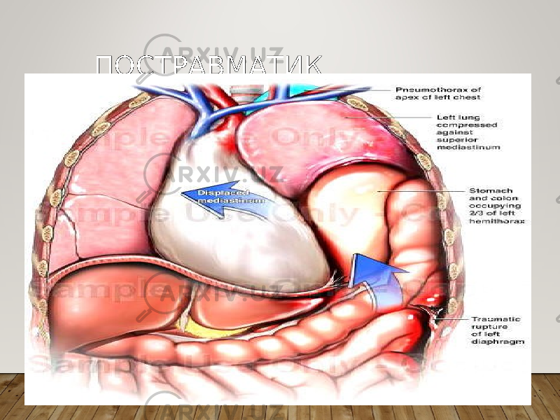 ПОСТРАВМАТИК ДИАФРАГМАЛ ЧУРРА 