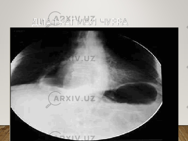 ДИАФРАГМАЛ ЧУРРА ОБЗОР РЕНТГЕНОГРАФИЯ 