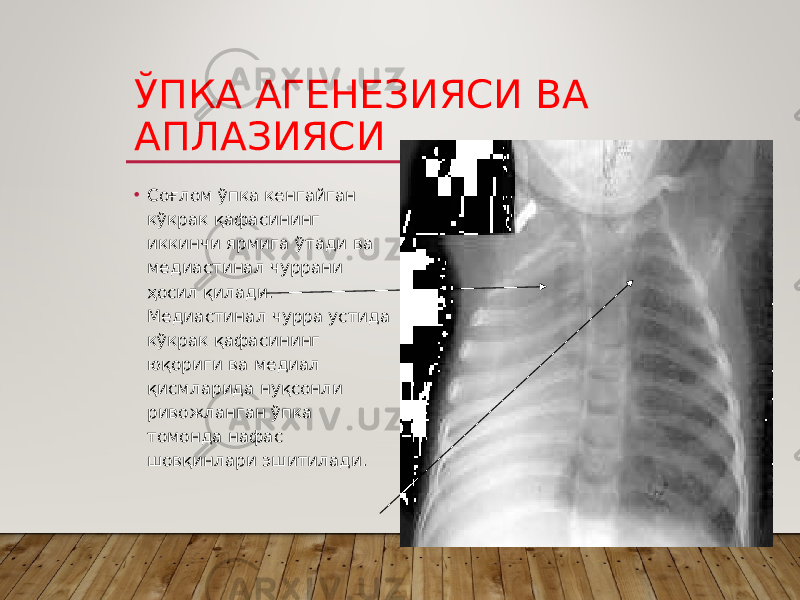 ЎПКА АГЕНЕЗИЯСИ ВА АПЛАЗИЯСИ • Соғлом ўпка кенгайган кўкрак қафасининг иккинчи ярмига ўтади ва медиастинал чуррани ҳосил қилади. Медиастинал чурра устида кўкрак қафасининг юқориги ва медиал қисмларида нуқсонли ривожланган ўпка томонда нафас шовқинлари эшитилади. 