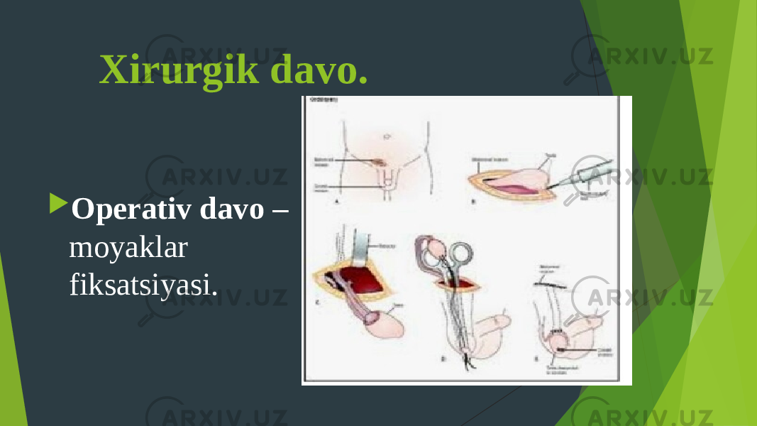  Xirurgik davo.  Operativ davo – moyaklar fiksatsiyasi. 