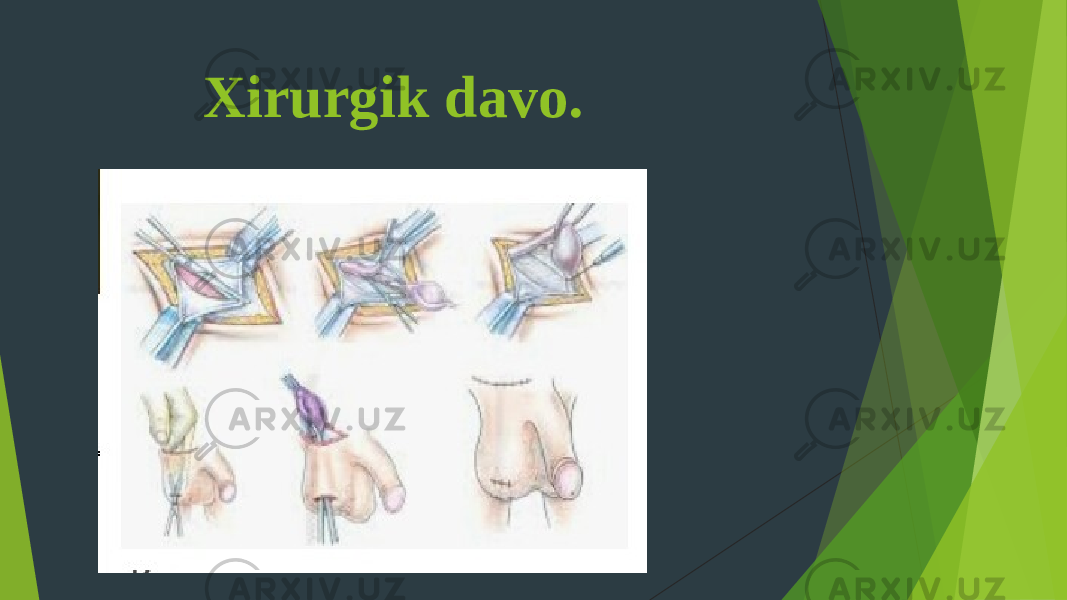  Xirurgik davo. 