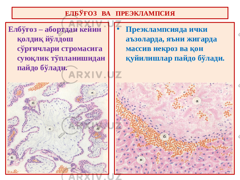 ЕЛБЎҒОЗ ВА ПРЕЭКЛАМПСИЯ Елбўғоз – абортдан кейин қолдиқ йўлдош сўрғичлари стромасига суюқлик тўпланишидан пайдо бўлади. • Преэклампсияда ички аъзоларда, яъни жигарда массив некроз ва қон қуйилишлар пайдо бўлади. 
