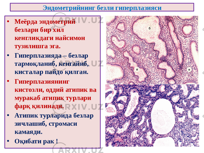 Эндометрийнинг безли гиперплазияси • Меёрда эндометрий безлари бир хил кенгликдаги найсимон тузилишга эга. • Гиперплазияда – безлар тармоқланиб, кенгайиб, кисталар пайдо қилган. • Гиперплазиянинг кистозли, оддий атипик ва муракаб атипик турлари фарқ қилинади. • Атипик турларида безлар зичлашиб, стромаси камаяди. • Оқибати рак ! 