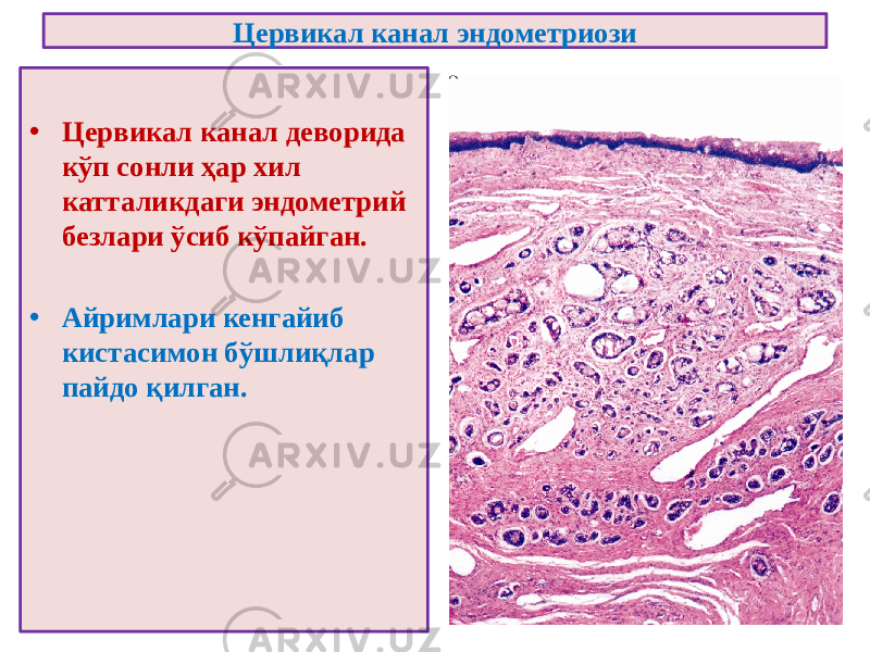 Цервикал канал эндометриози • Цервикал канал деворида кўп сонли ҳар хил катталикдаги эндометрий безлари ўсиб кўпайган. • Айримлари кенгайиб кистасимон бўшлиқлар пайдо қилган. 