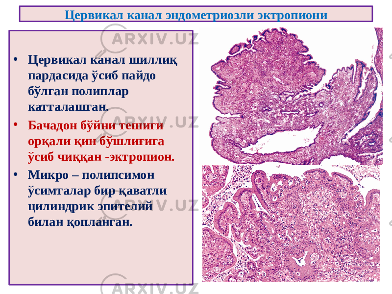 Цервикал канал эндометриозли эктропиони • Цервикал канал шиллиқ пардасида ўсиб пайдо бўлган полиплар катталашган. • Бачадон бўйни тешиги орқали қин бўшлиғига ўсиб чиққан -эктропион. • Микро – полипсимон ўсимталар бир қаватли цилиндрик эпителий билан қопланган. 