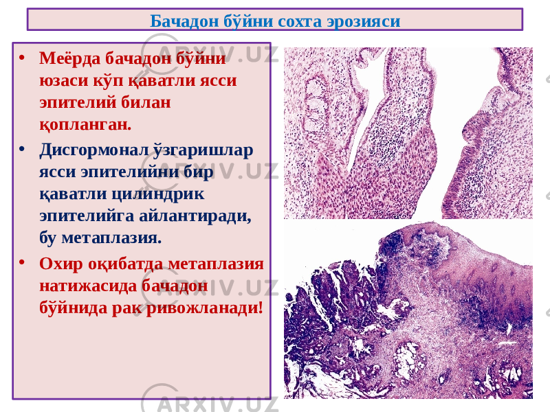 Бачадон бўйни сохта эрозияси • Меёрда бачадон бўйни юзаси кўп қаватли ясси эпителий билан қопланган. • Дисгормонал ўзгаришлар ясси эпителийни бир қаватли цилиндрик эпителийга айлантиради, бу метаплазия. • Охир оқибатда метаплазия натижасида бачадон бўйнида рак ривожланади! 