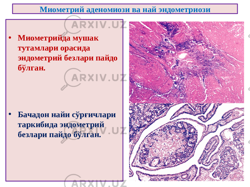 Миометрий аденомиози ва най эндометриози • Миометрийда мушак тутамлари орасида эндометрий безлари пайдо бўлган. • Бачадон найи сўрғичлари таркибида эндометрий безлари пайдо бўлган. 