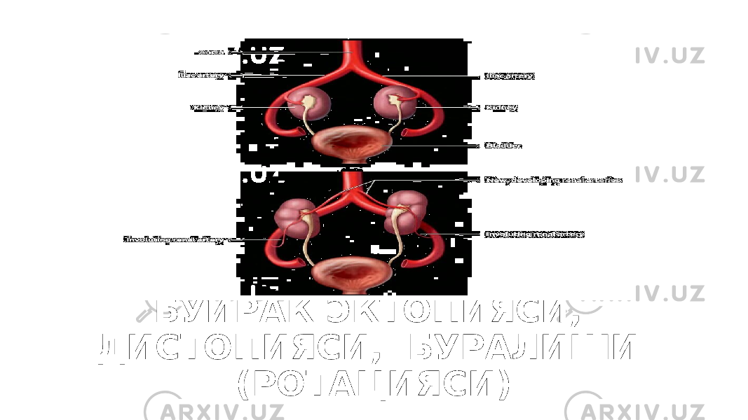 БУЙРАК ЭКТОПИЯСИ, ДИСТОПИЯСИ, БУРАЛИШИ (РОТАЦИЯСИ) 