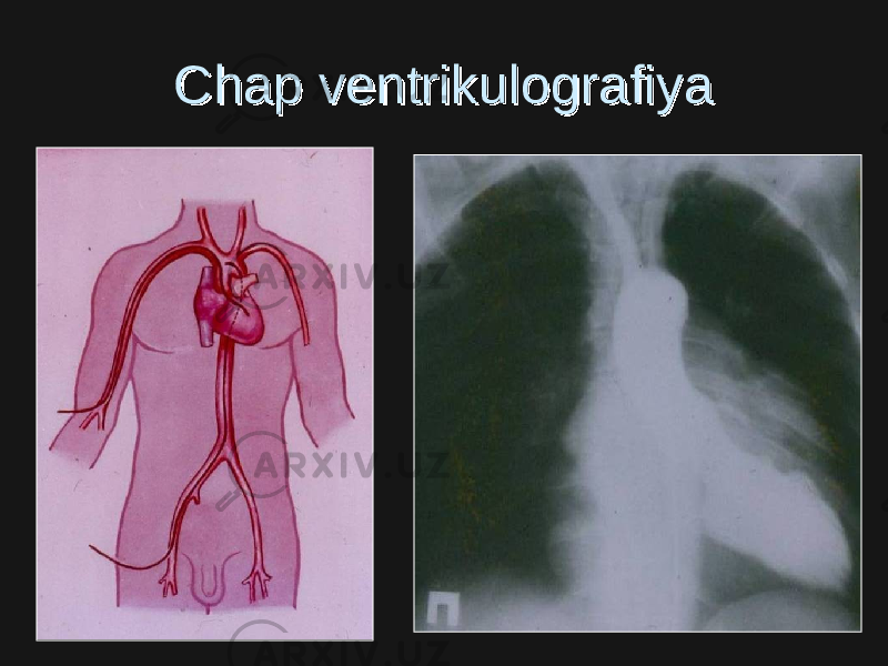 Chap ventrikulografiyaChap ventrikulografiya 