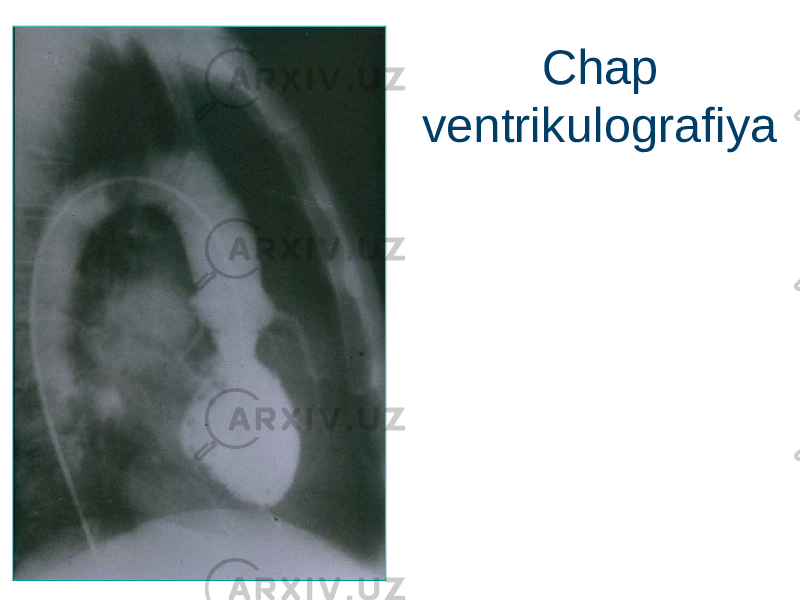 Chap ventrikulografiya 