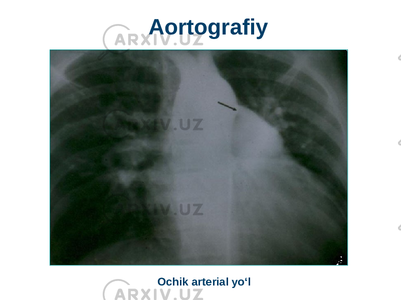 Ochik arterial yo‘lAortografiy 