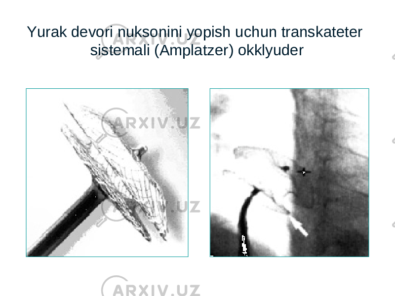 Yurak devori nuksonini yopish uchun transkateter sistemali (Amplatzer) okklyuder 