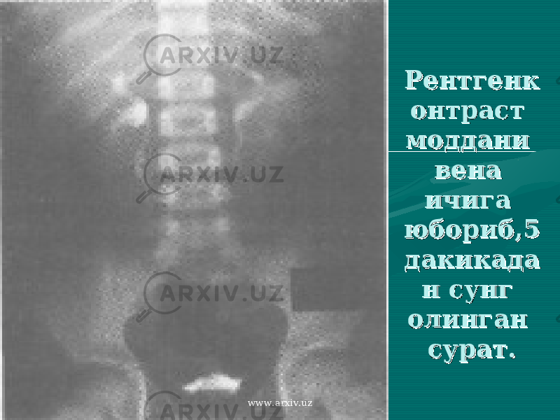 РентгенкРентгенк онтраст онтраст моддани моддани вена вена ичига ичига юбориб,5 юбориб,5 дакикададакикада н сунг н сунг олинган олинган сурат.сурат. www.arxiv.uz 