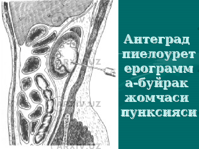 Антеград Антеград пиелоуретпиелоурет ерограммерограмм а-буйрак а-буйрак жомчаси жомчаси пунксиясипунксияси www.arxiv.uz 