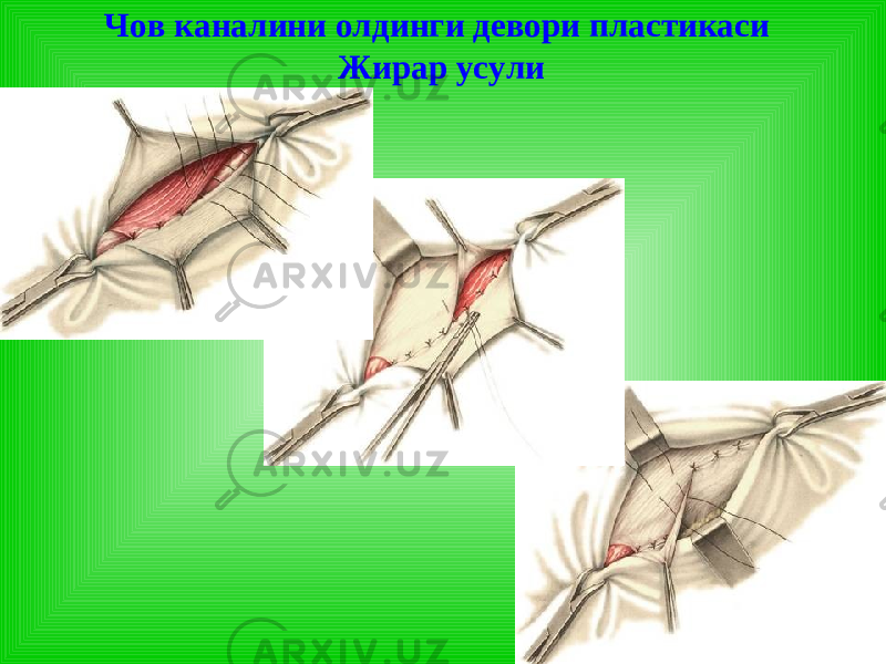 Чов каналини олдинги девори пластикаси Жирар усули 