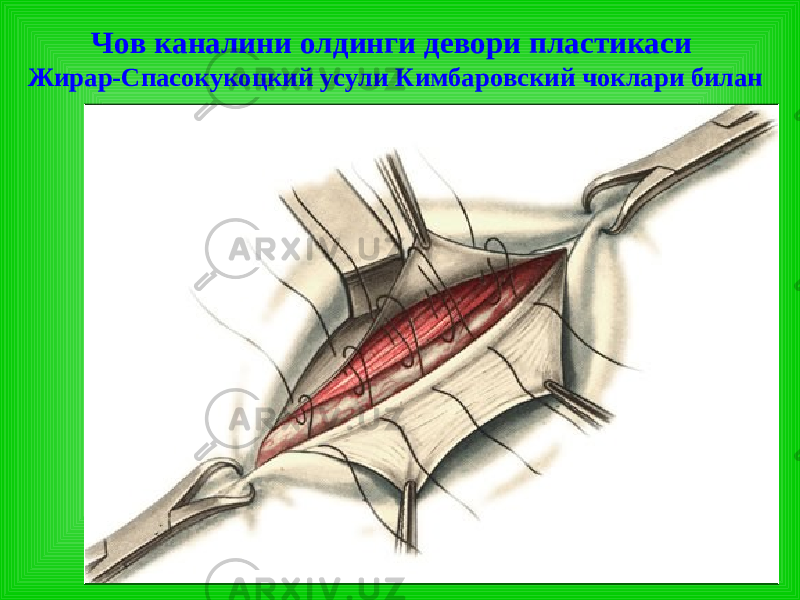 Чов каналини олдинги девори пластикаси Жирар-Спа с окукоцк ий усули Кимбаровск ий чоклари билан 