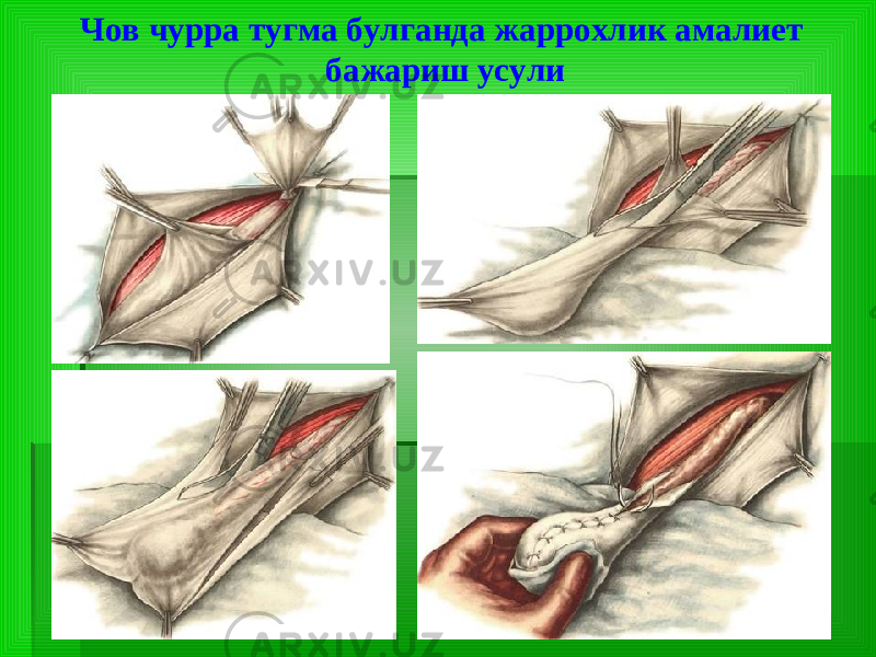 Чов чурра тугма булганда жаррохлик амалиет бажариш усули 