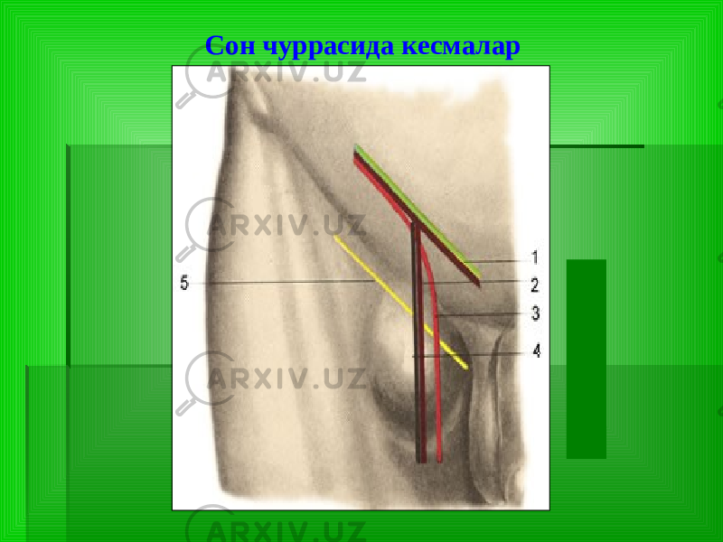 Сон чуррасида кесмалар 